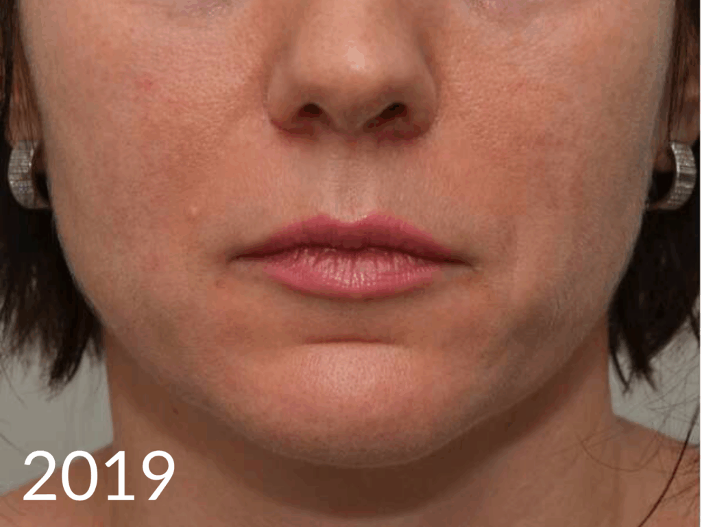 Sculptra voor