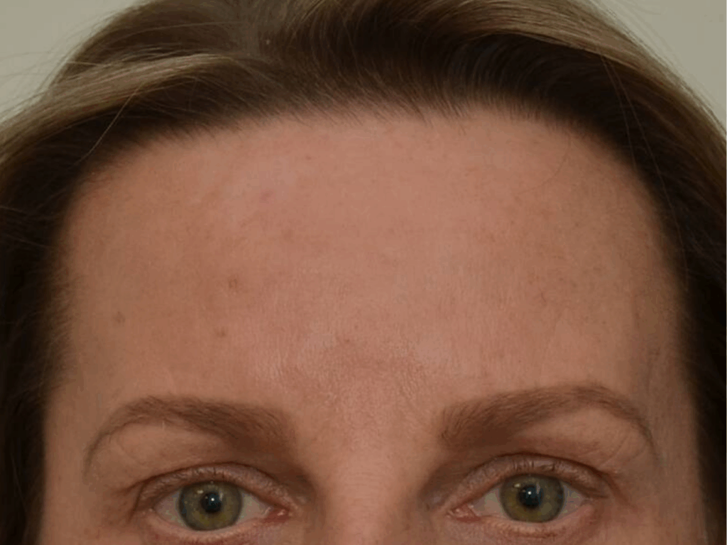Botox fronsrimpel na