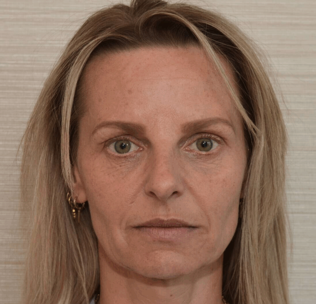 Fillers wangen na