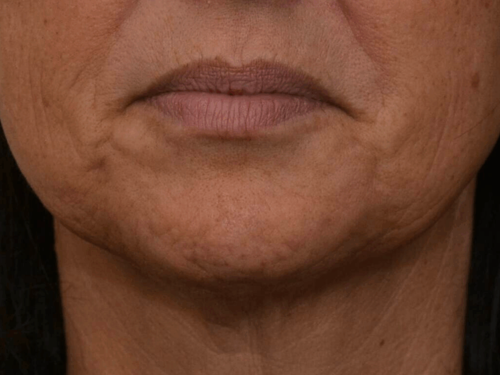 Botox afhangende mondhoeken voor