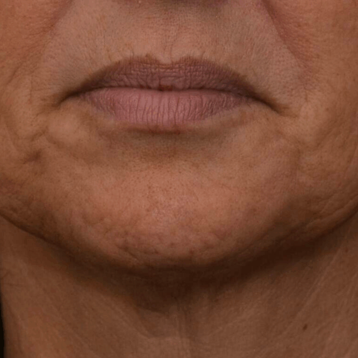 botox afhangende mondhoeken voor en na