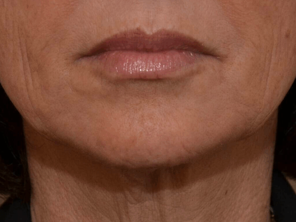Botox afhangende mondhoeken na