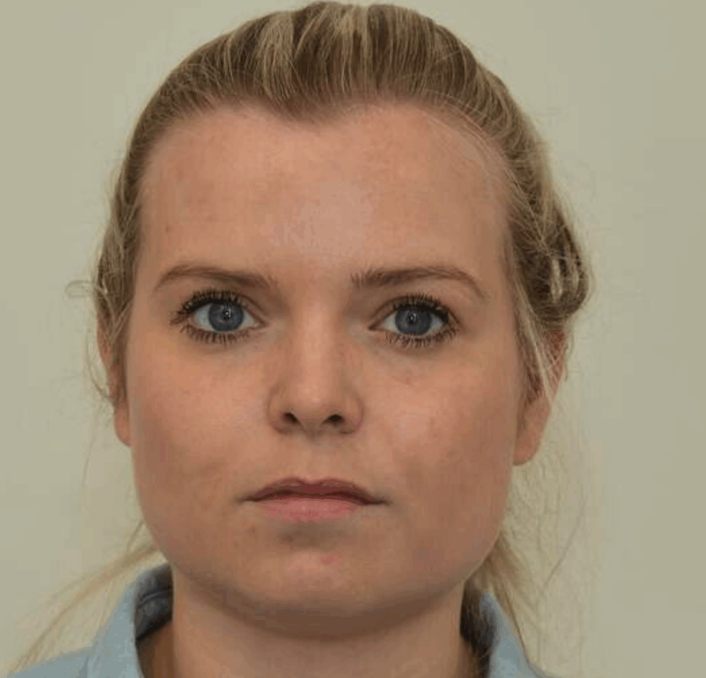 15 Facial slimming voor en na