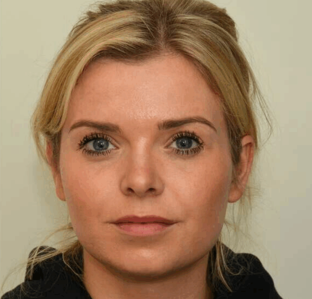 16 Facial slimming voor en na