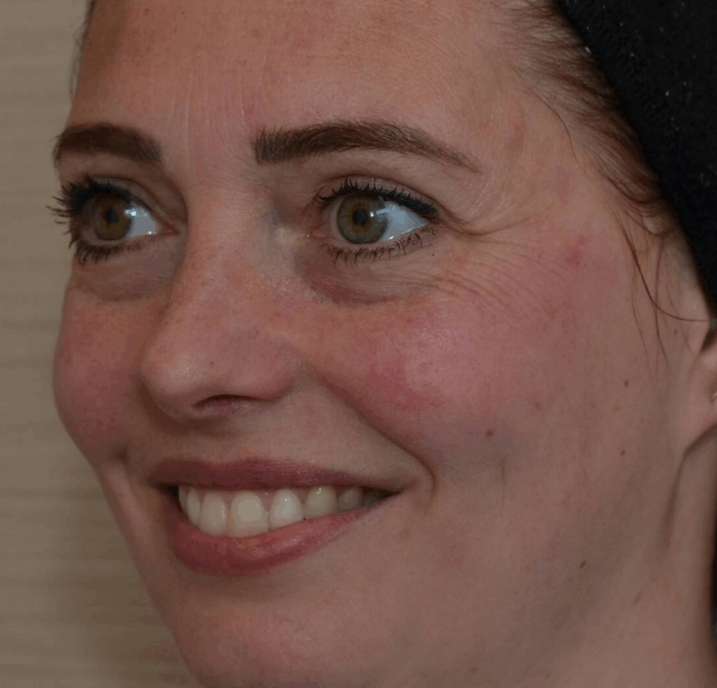 Botox kraaienpootjes voor