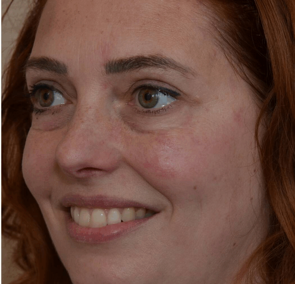 Botox kraaienpootjes na