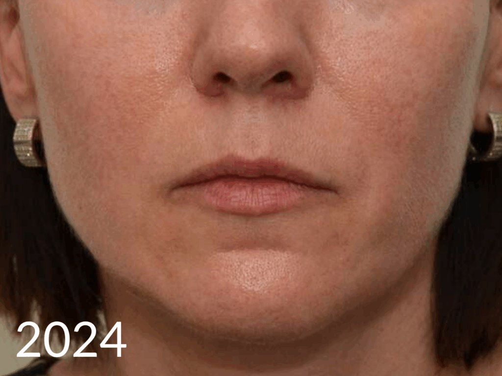 Sculptra na