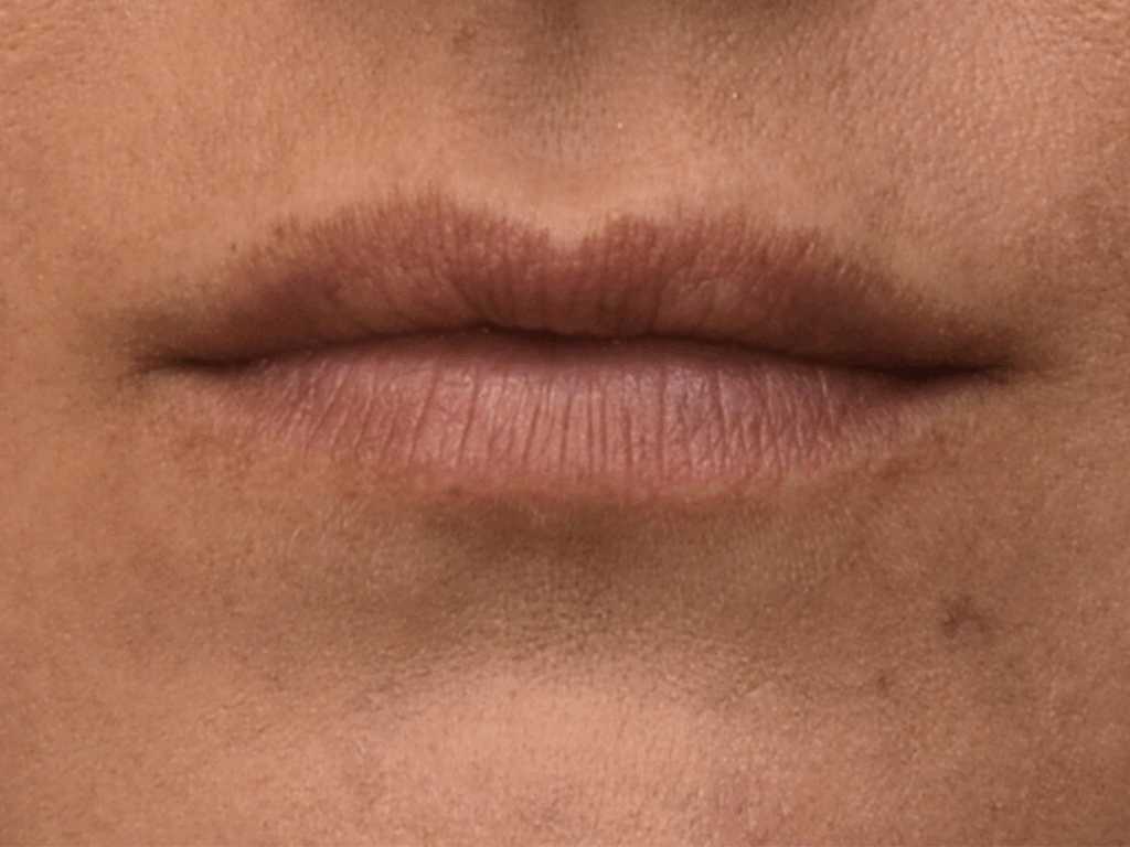 Lipfillers voor