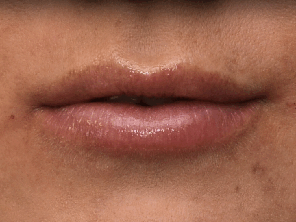 lipfillers na
