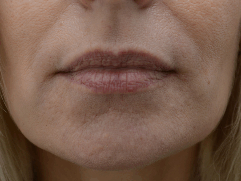 lipofilling voor