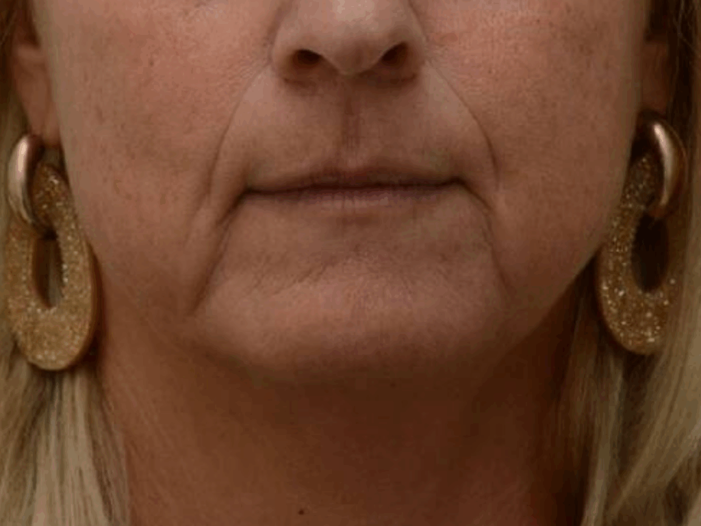 Mondhoeken filler voor