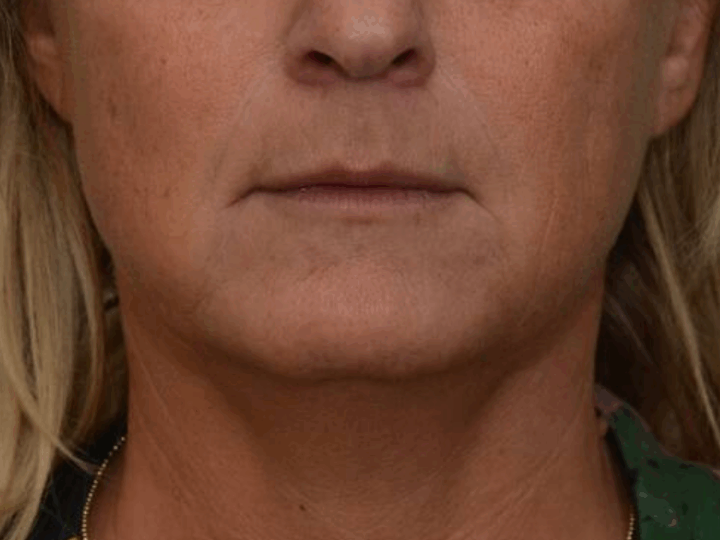 Mondhoeken filler na