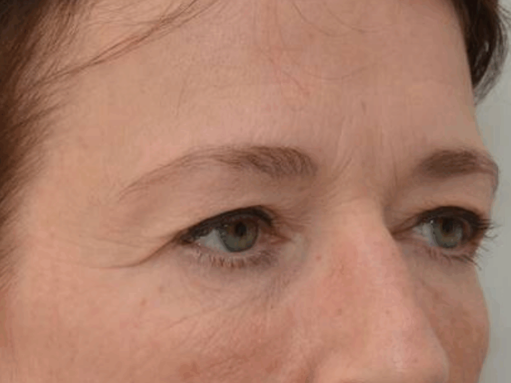 Botox wenkbrauwlift voor