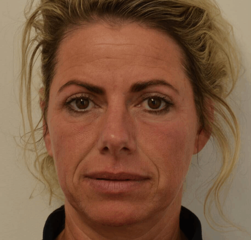 liquid facelift voor