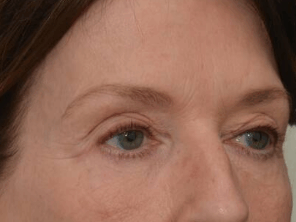 Botox wenkbrauwlift na