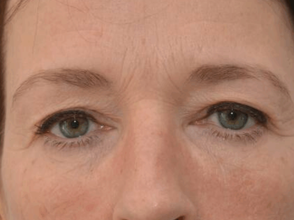 Botox wenkbrauwlift voor