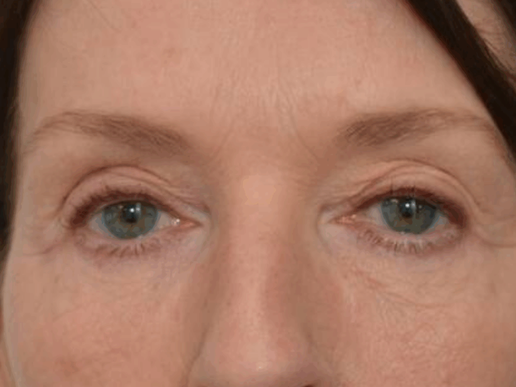 Botox wenkbrauwlift na