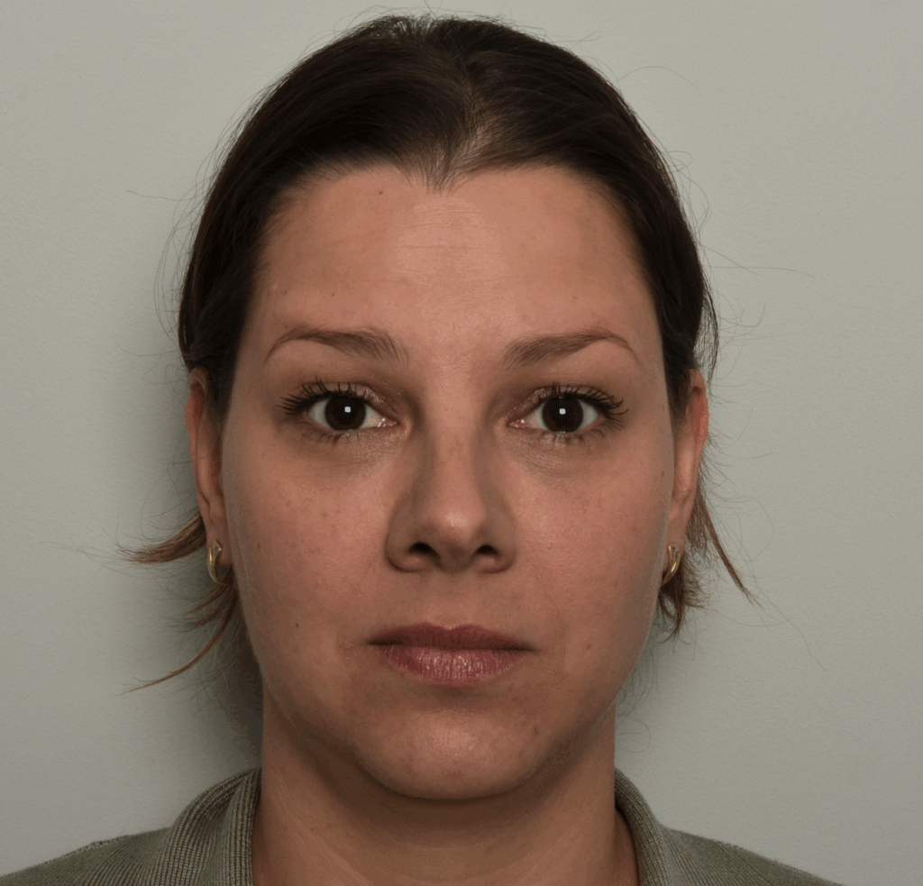 Botox voorhoofd na