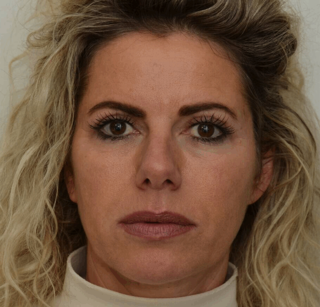liquid facelift after