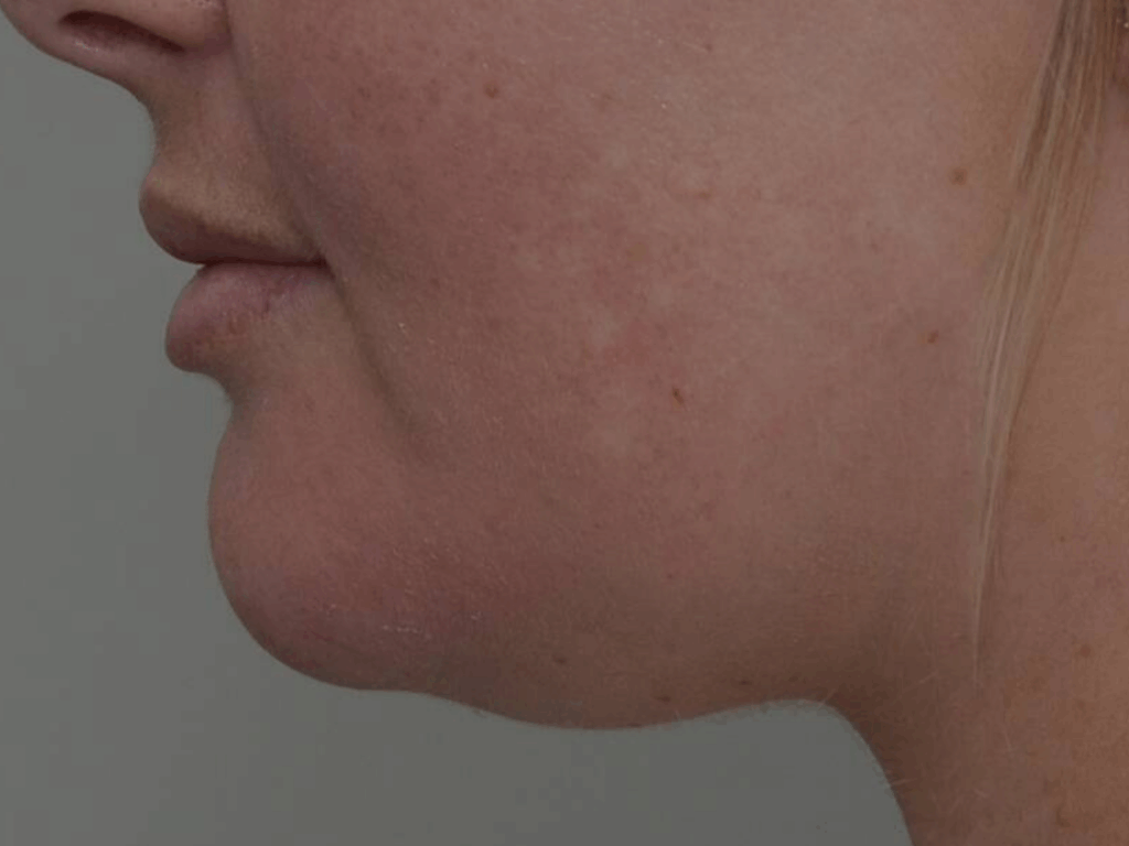 Belkyra Kybella onderkin voor en na