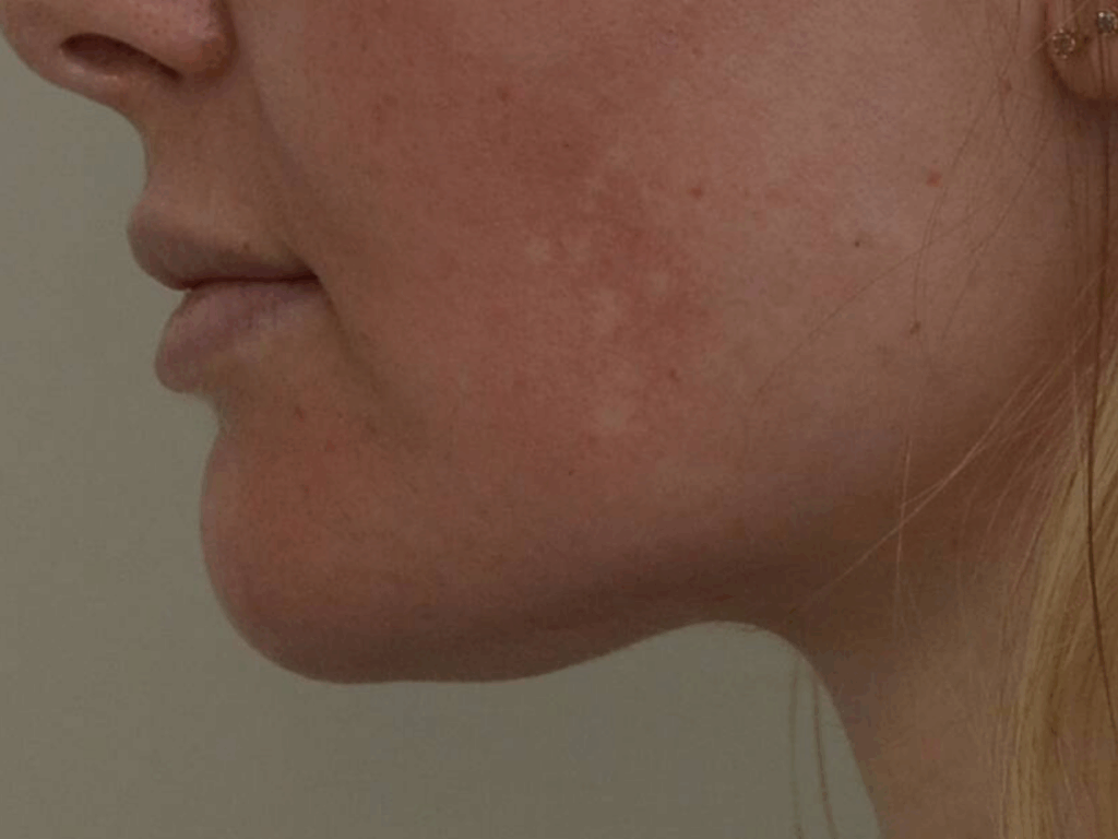 Belkyra Kybella onderkin voor en na 2