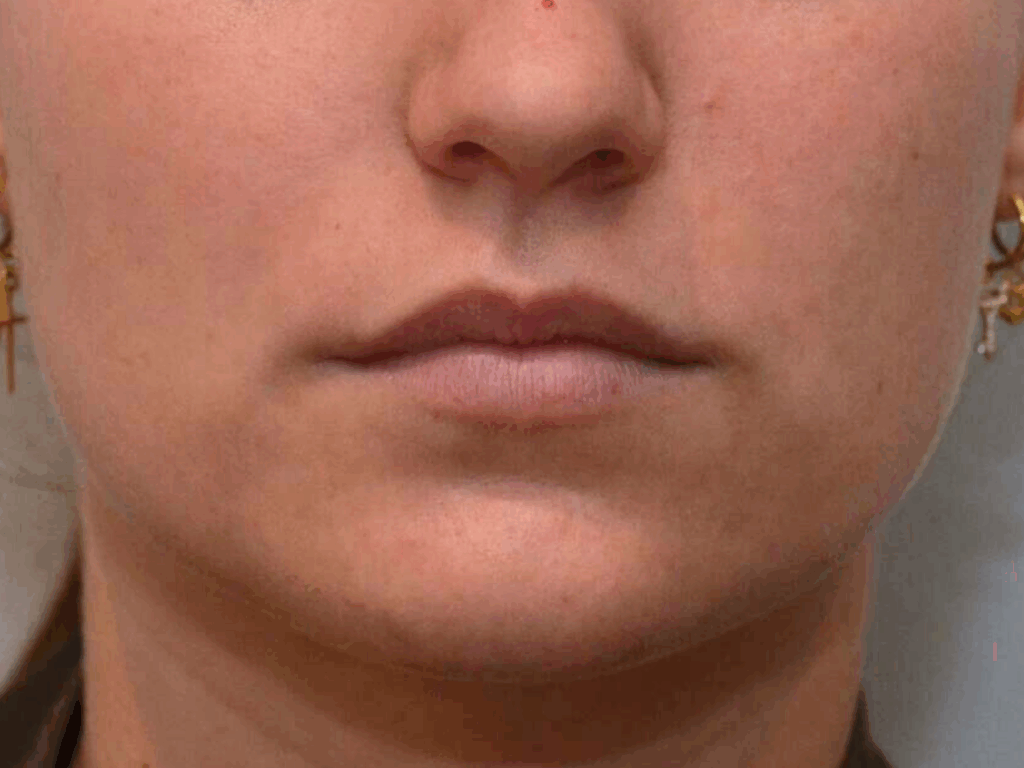 Lipfiller voor