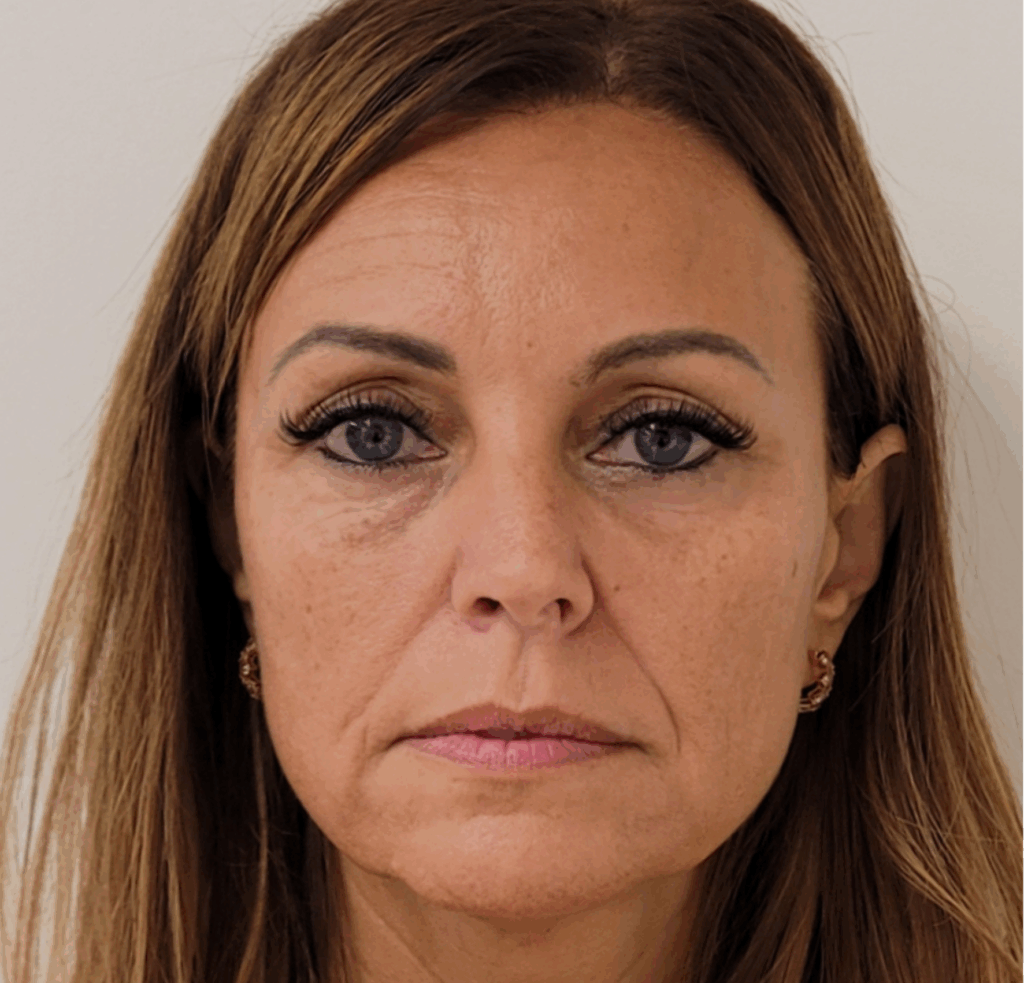 Liquid Facelift voor