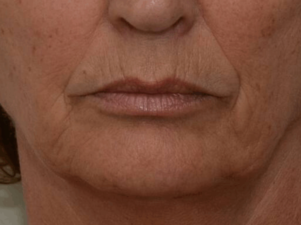 Neuslippenplooi filler voor