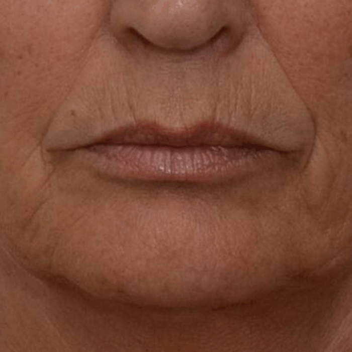 Neuslippenplooi filler voor