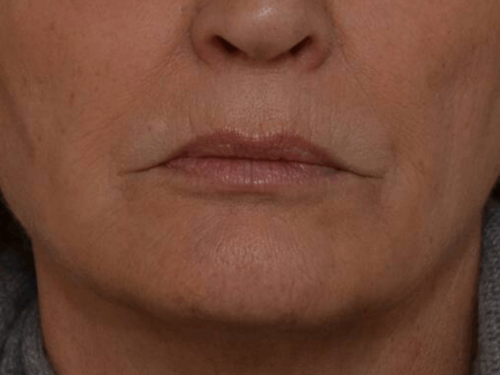 Neuslippenplooi filler na