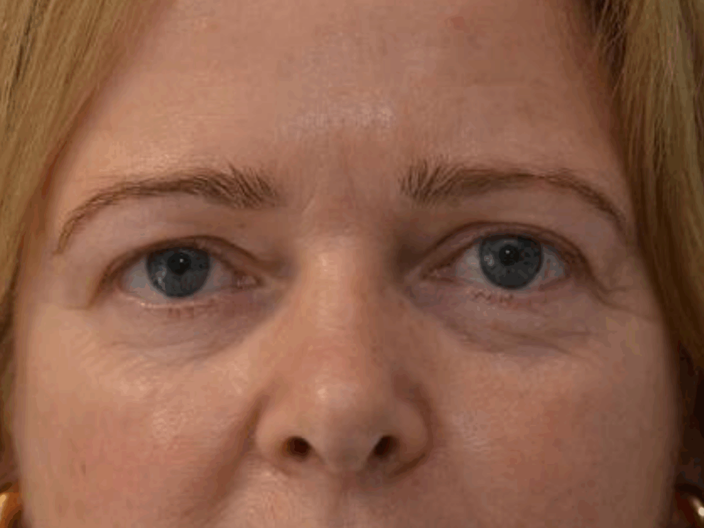 Wenkbrauwlift met botox voor