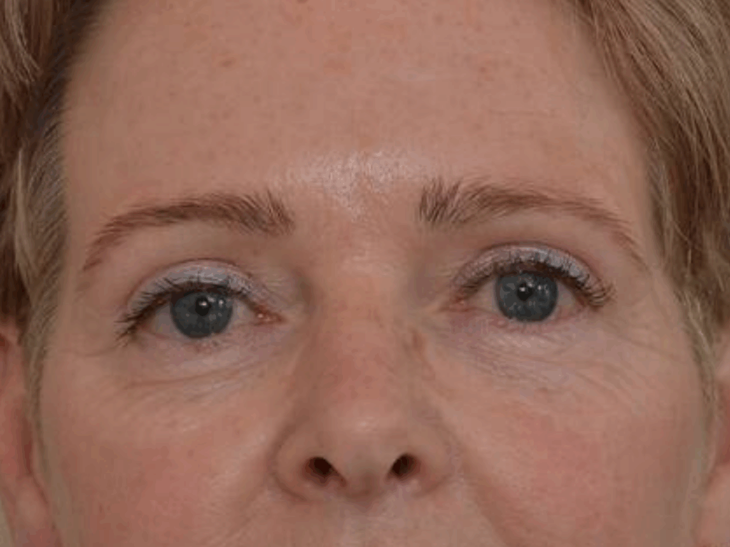 Wenkbrauwlift met botox na