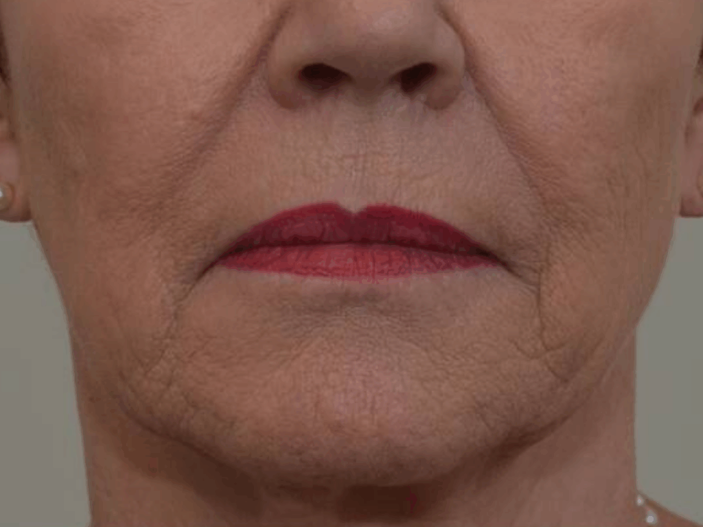 Skinbooster voor