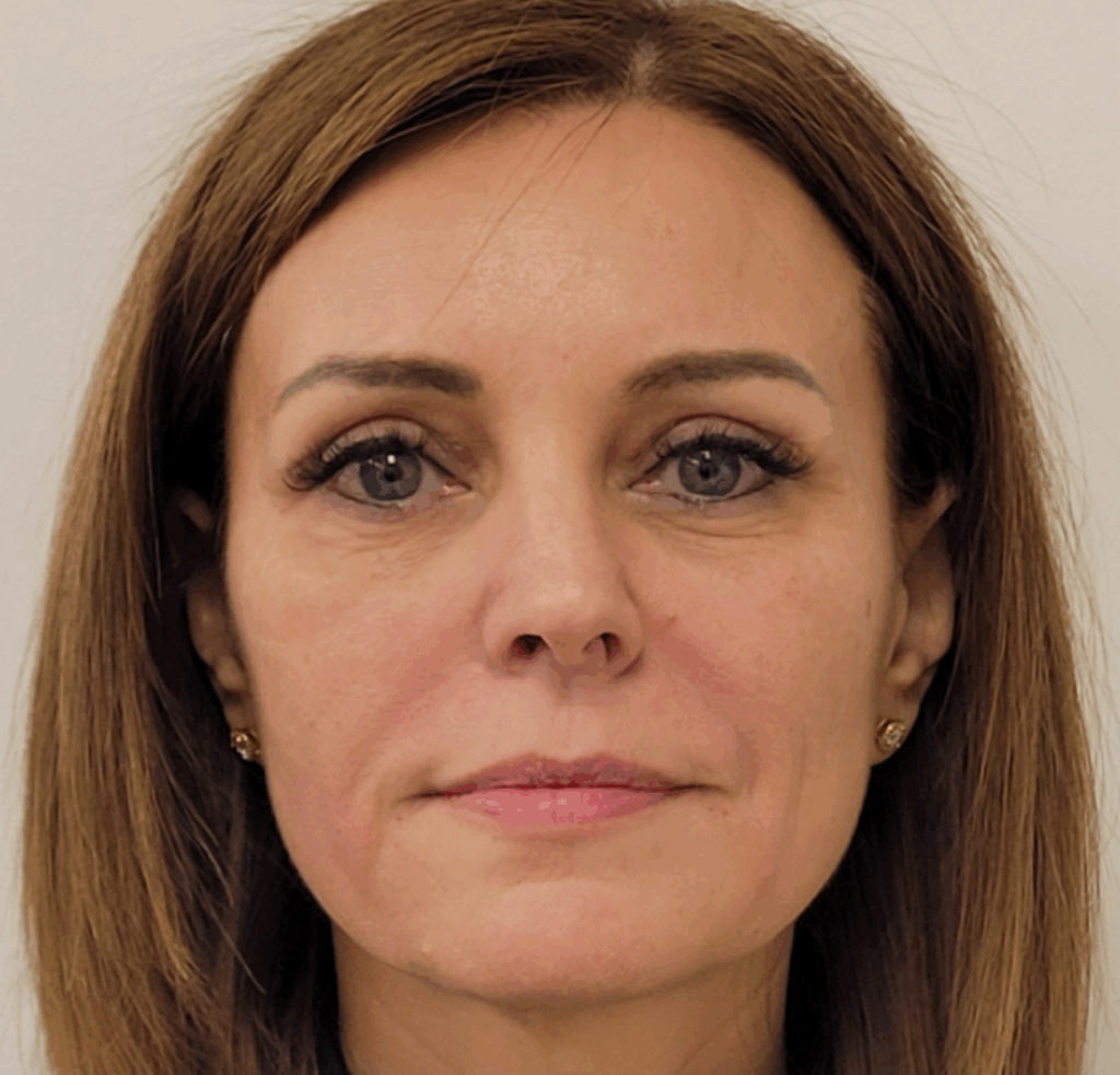 Liquid Facelift na