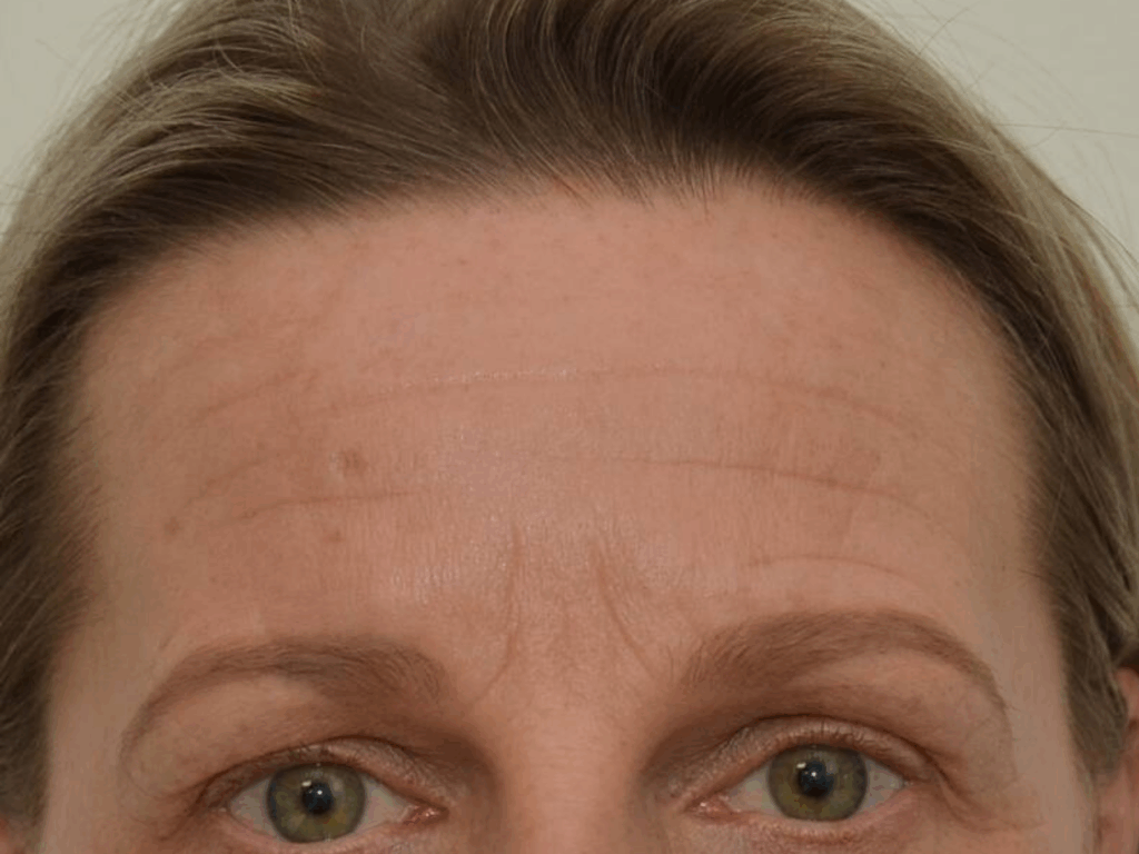 Botox fronsrimpel voor