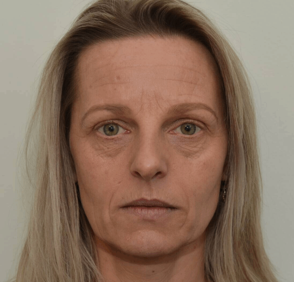 Fillers wangen voor