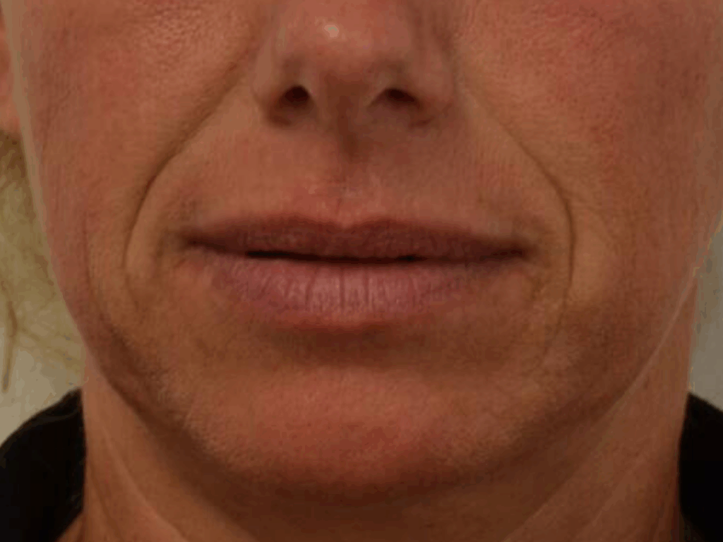 neuslippenplooi filler voor