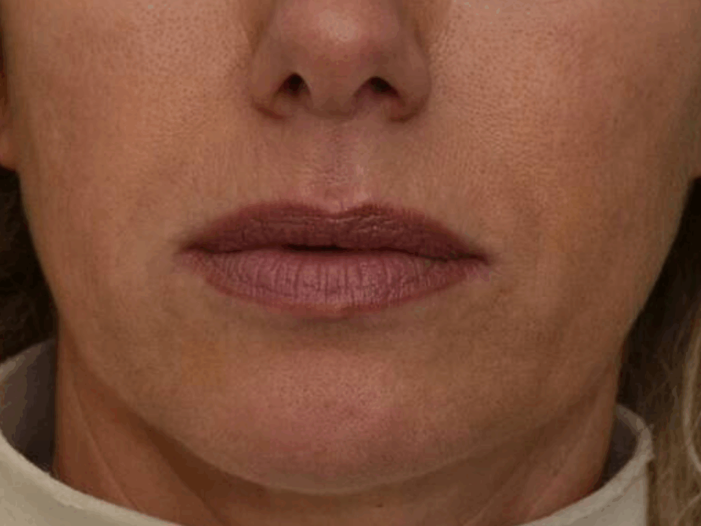 neuslippenplooi filler na