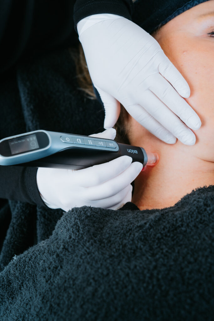 Microneedling met LED bij DokterEs Eindhoven