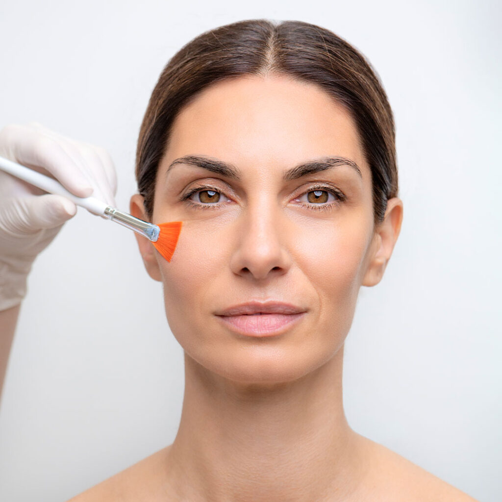 TCA peeling bij DokterEs Eindhoven