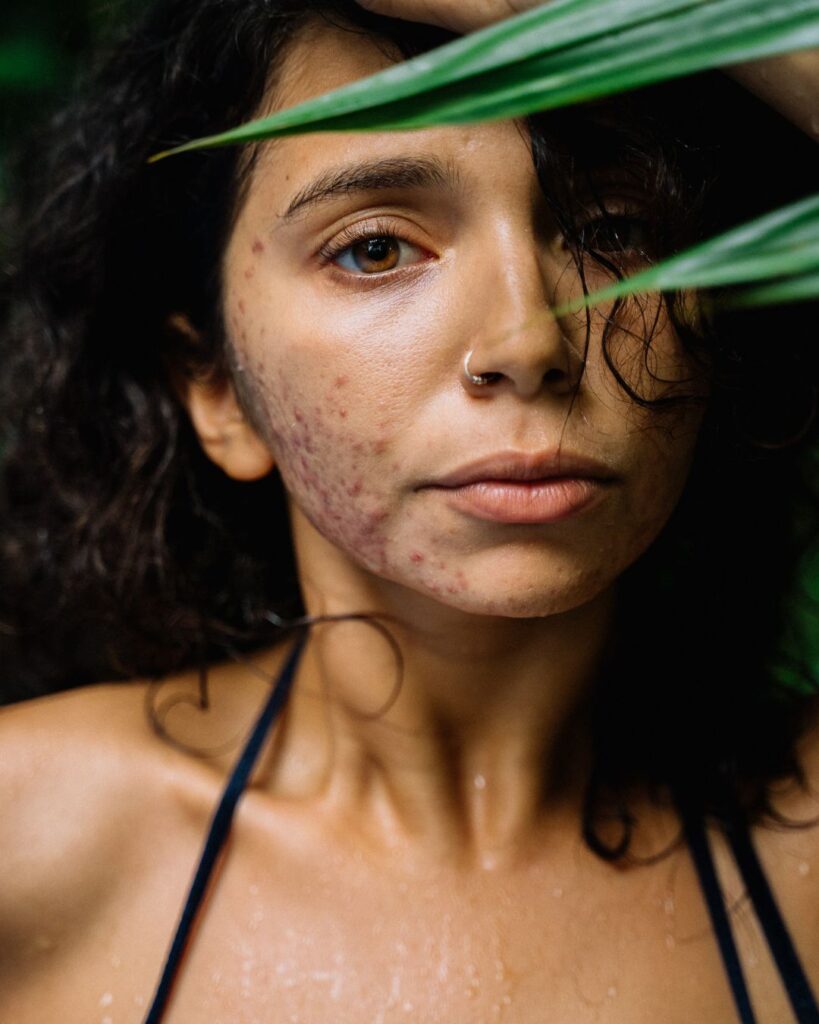 Acne behandeling DokterEs