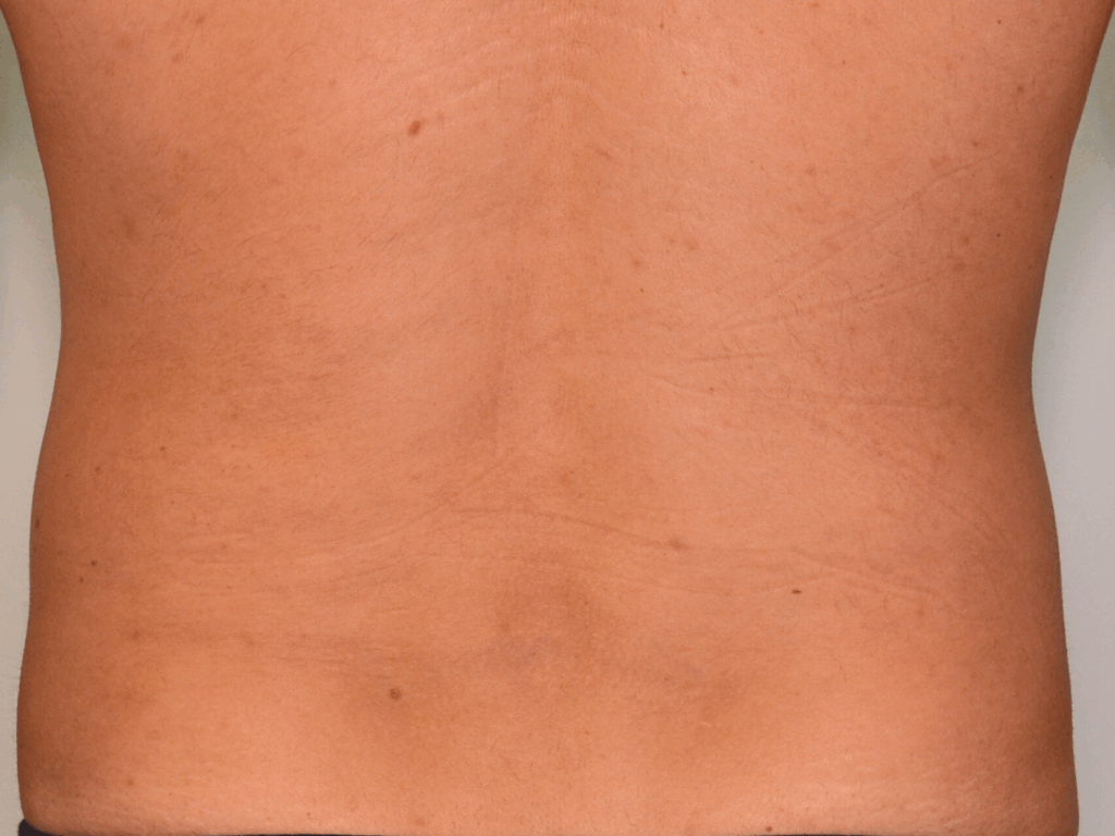 Striae en losse huid Na