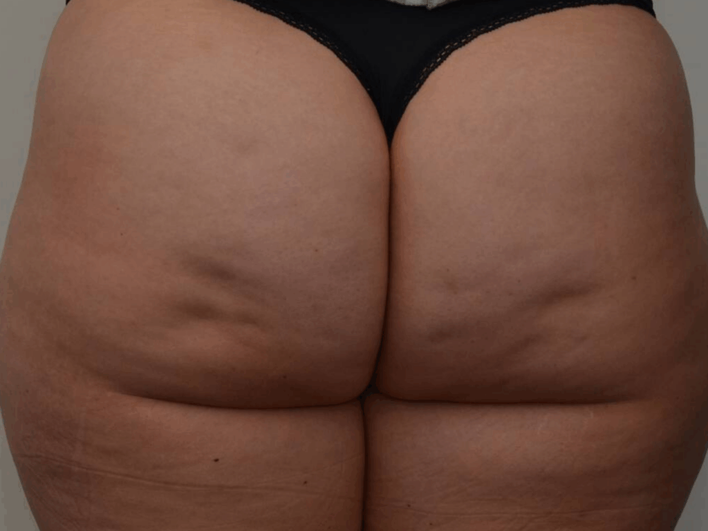 Cellulite billen voor