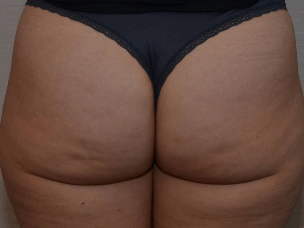 Cellulite billen na