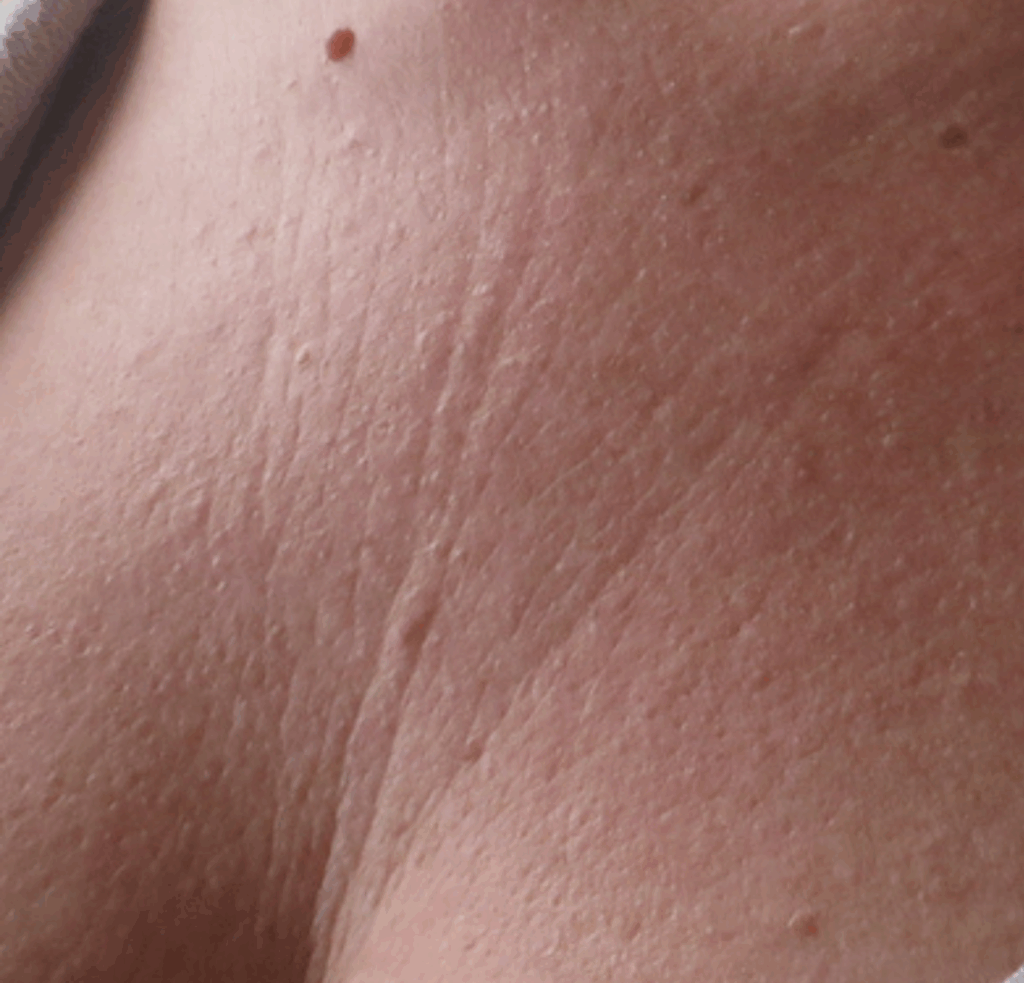 Skinboosters decollete voor