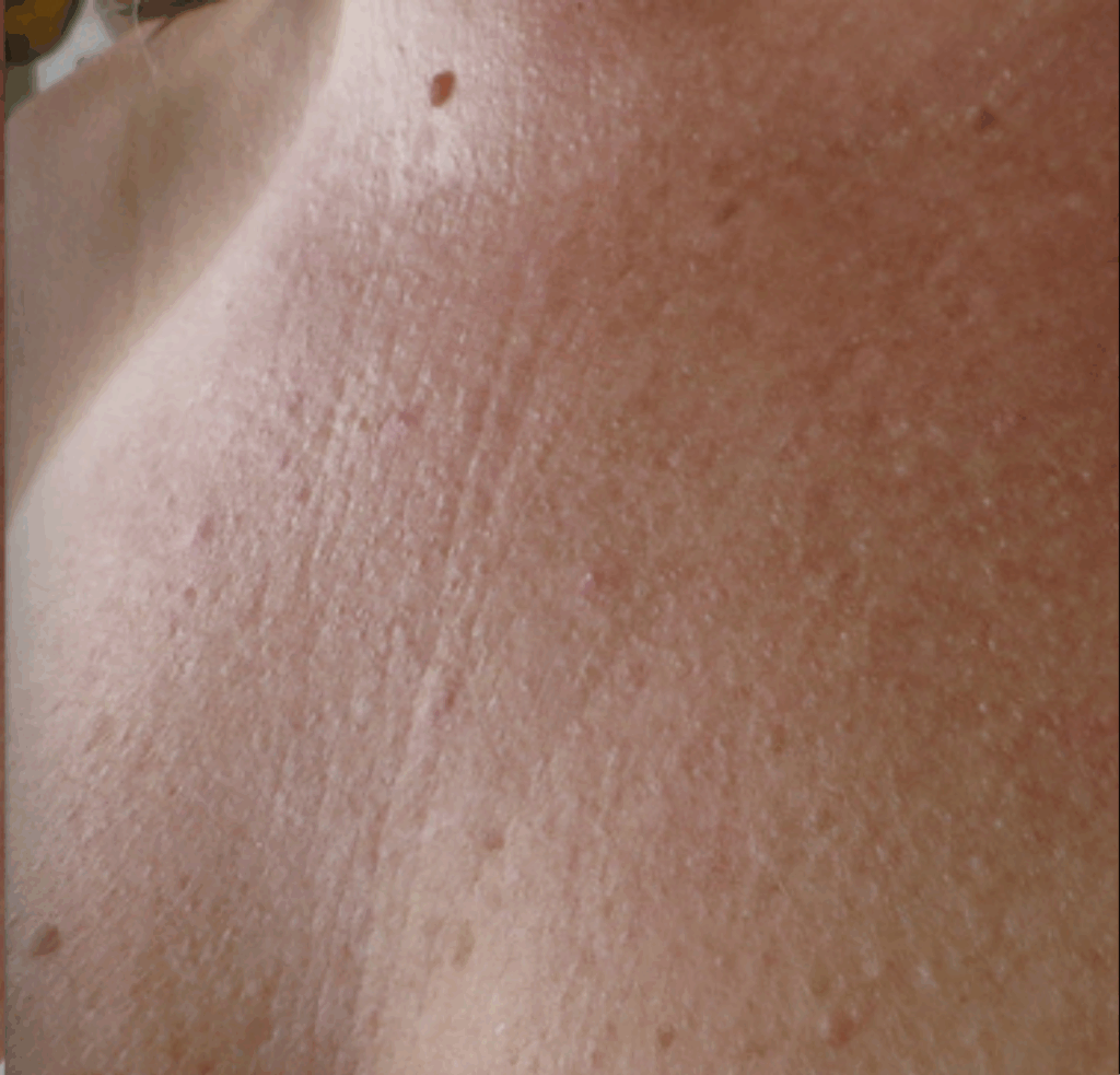 Skinboosters decollete na