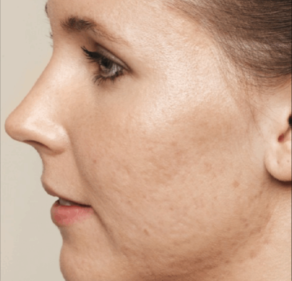 Acne littekens met restylane skinbooster voor en na