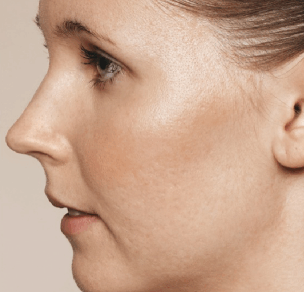 Acne littekens met restylane skinbooster voor en na