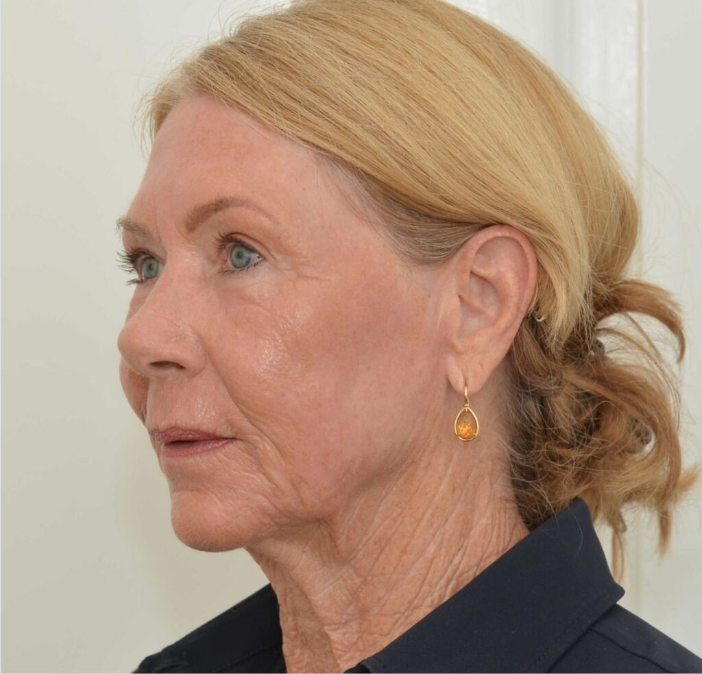 CO2 full-face and neck DokterEs after