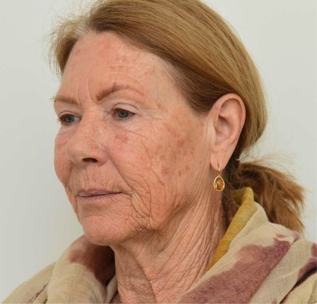 CO2 full-face and neck DokterEs for